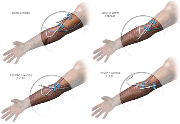 Endovascular AV Fistula Creation and Use